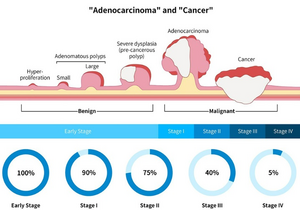 Different stages of colorectal cancer