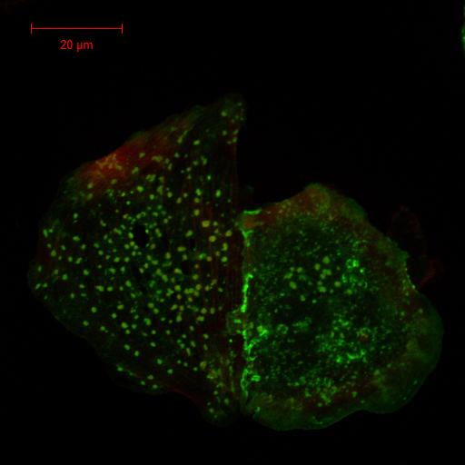 First Inherited Mutation in SRC Cancer Gene Identified in Humans (2 of 2)