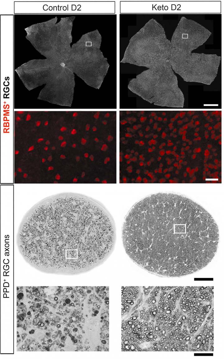 Keto Diet Preserves Retina