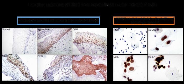 New Technology Developed for Early Detection of Cervical Precancerous Pesions