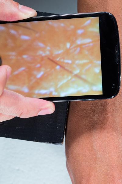 3-D-Printed Dermascope for $2