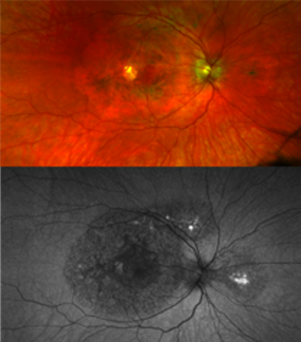 TIMP3-related retinopathy