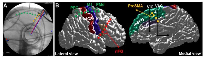 Brain stimulation [IMAGE] | EurekAlert! Science News Releases