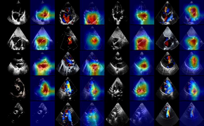 Fig. 3. CAM figures of testing images. The first 2 columns indicate ASD, and the last 2 columns signify VSD.