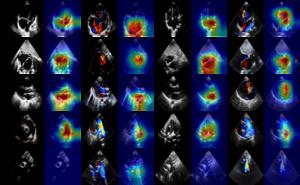 Fig. 3. CAM figures of testing images. The first 2 columns indicate ASD, and the last 2 columns signify VSD.