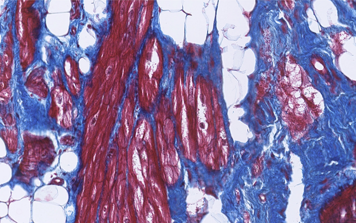 Figure 1: Patches of fibrosis (blue) and fat (white) tissue in the heart of an ACM patient. Heart muscle cells are shown in red.