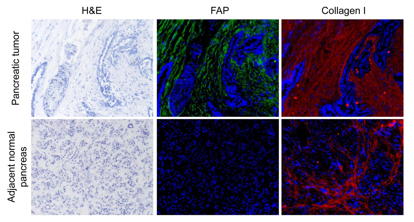 FAP Expression and Cancer Prognosis