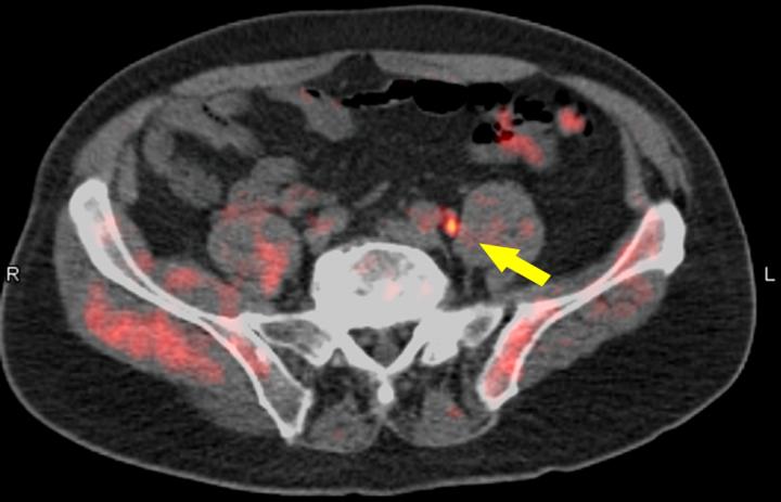 Fused PET/CT 18F-fluciclovine Image 