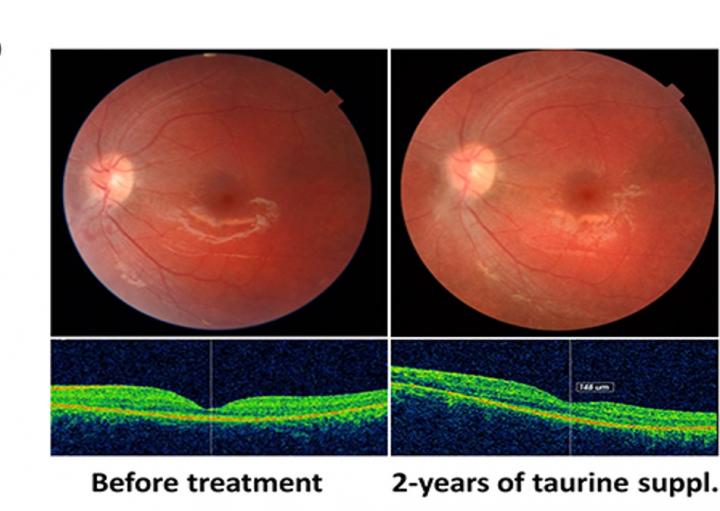 Patient's Left Fundus