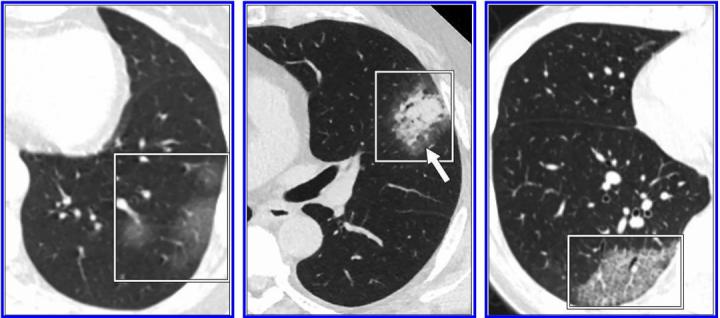 CT Features Indicating Changes in Lungs Caused by Coronavirus Disease 2019 Pneumonia
