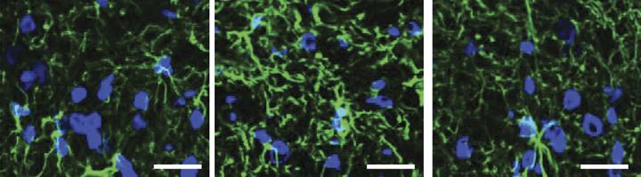 Bortezomib's Neuropathic Effects Are Reversed by Fingolimod