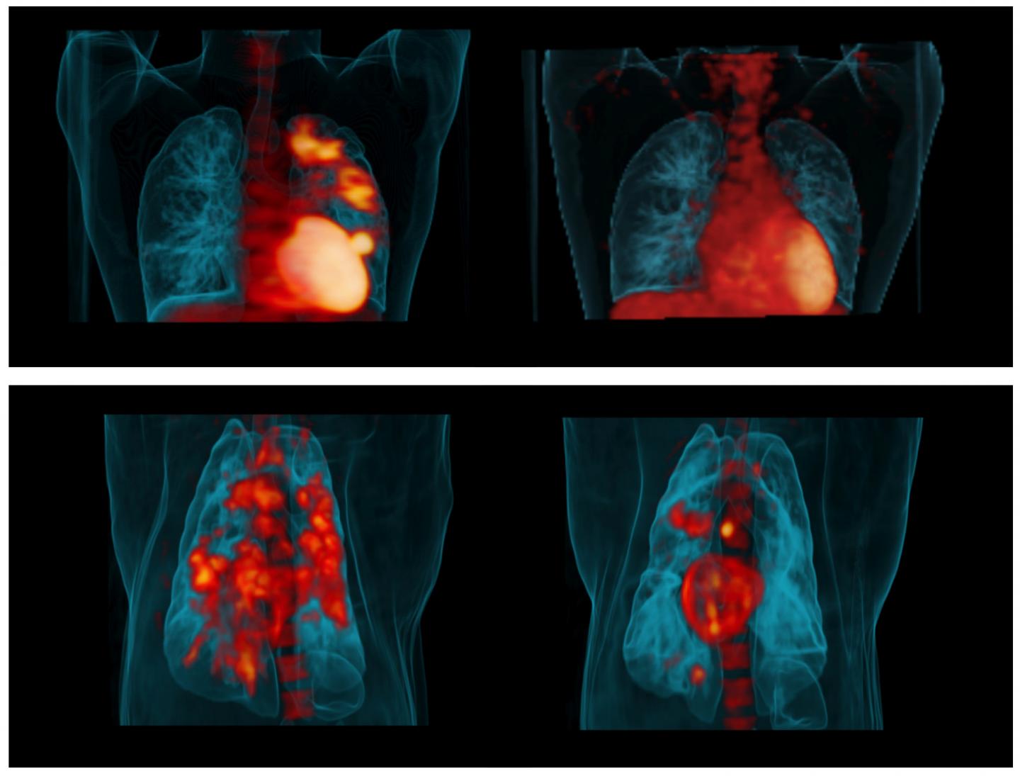 Imaging Technology May Speed Up Identification of New Tuberculosis Drugs (1 of 2)