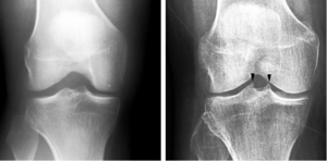 Spiking on the tibial tubercles in the knee joint