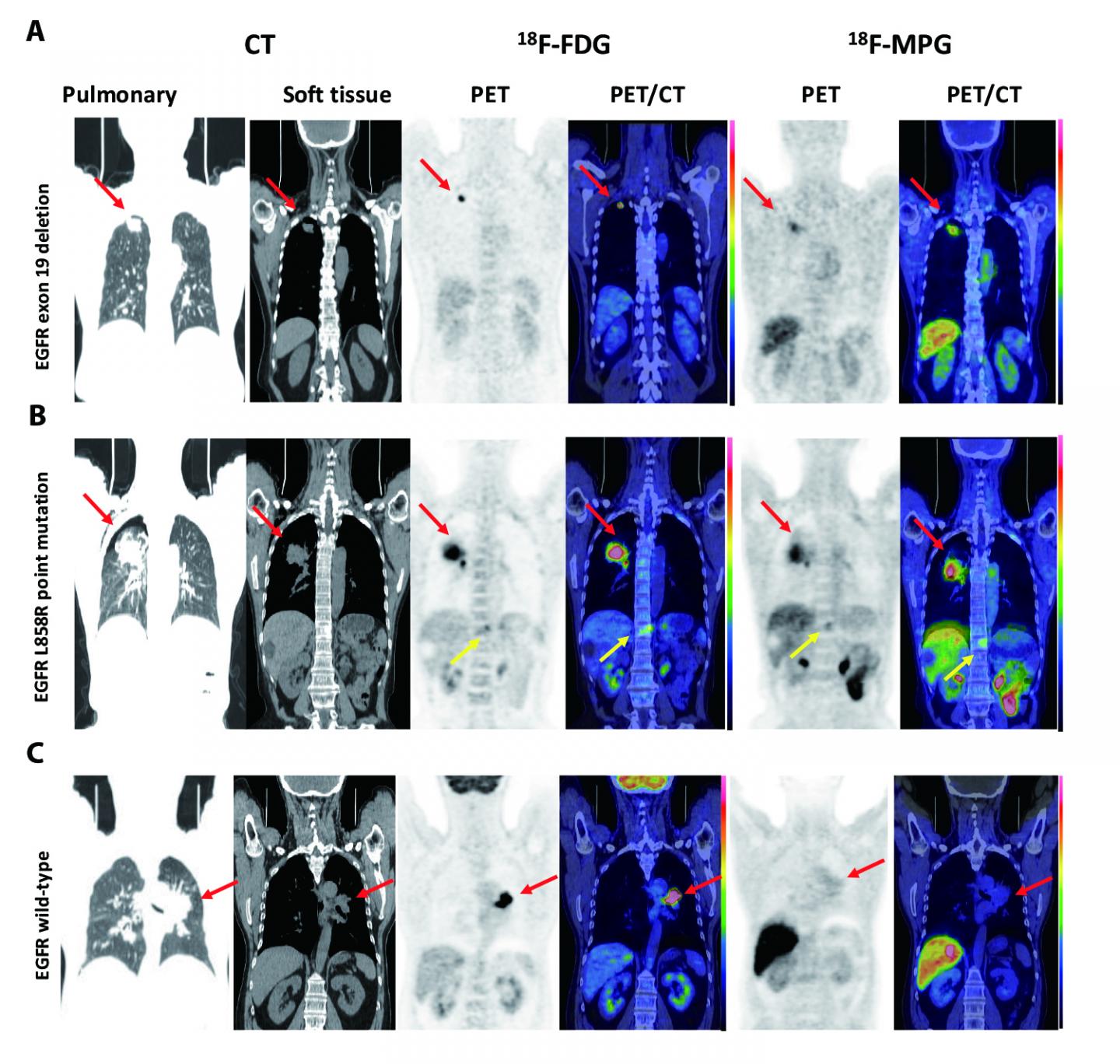 Tracer Shows Which Lung Cancer Patients May Benefit from Tyrosine Kinase Inhibitors (1 of 1)