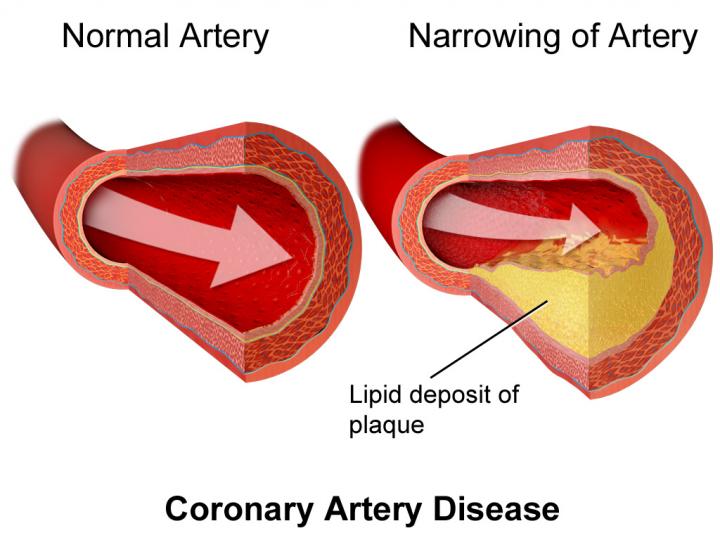 Atherosclerosis