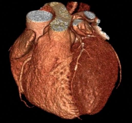 Routine CT Scans for Clinic Patients May Cut Heart Attack Risk