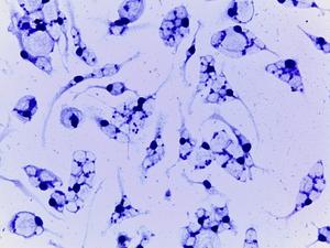 Resistance to the main drugs used in Brazil against Leishmania is found in parasite infecting cutaneous leishmaniasis patient