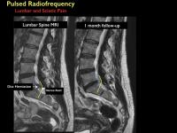 Image of Herniated Disc before Treatment and at 1-Month Follow-Up