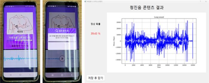 Analysis of Abnormalities in Breathing Sounds using Auscultation Sounds