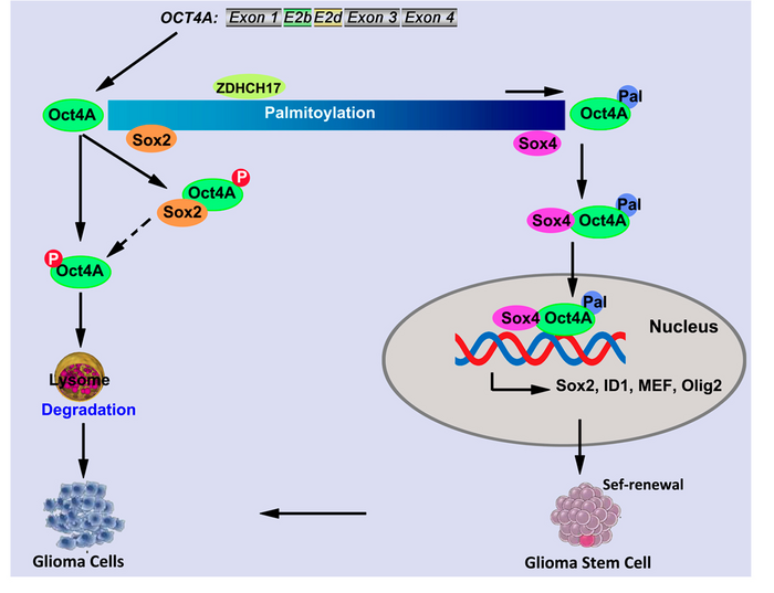 Key Factor Found in Tumorigenicity of Glioma Stem Cells