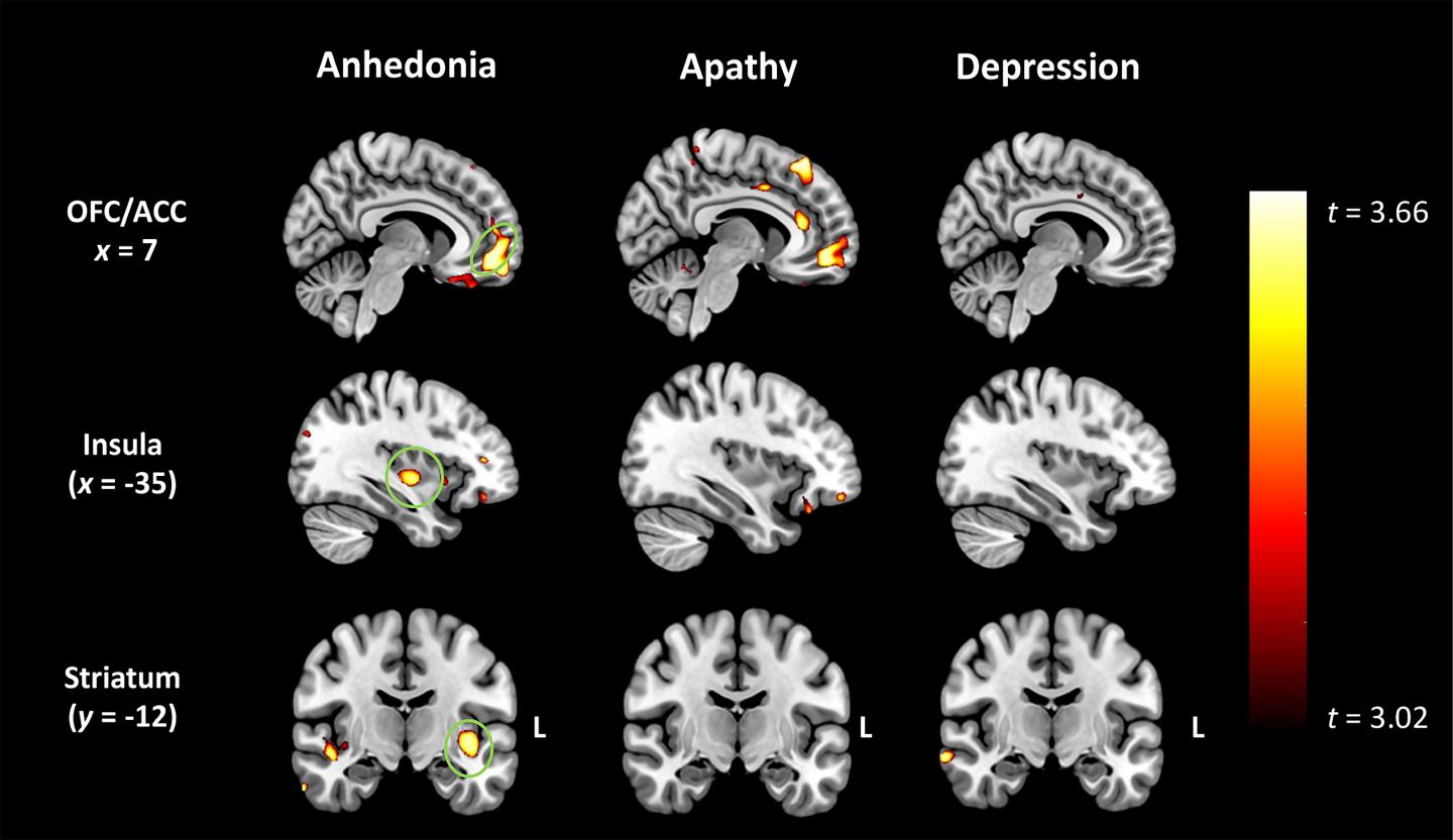 Scans reveal anhedonia in FTD related to degeneration of grey matter in the brain's pleasure regions