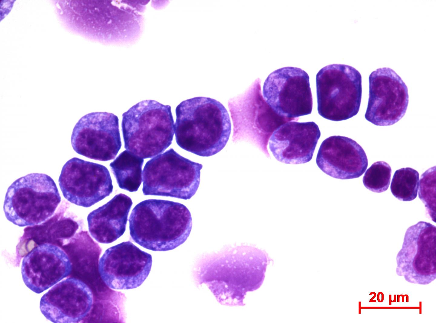 Leukemia Cells