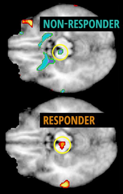 Responders, Nonresponders and Brain Glucose Metabolism