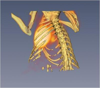 TB Monitoring System