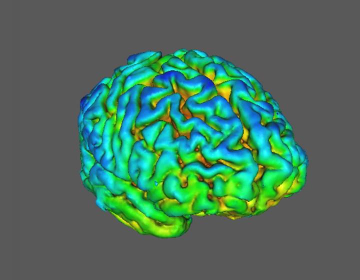 Schizophrenia SV2A Brain Scan Image