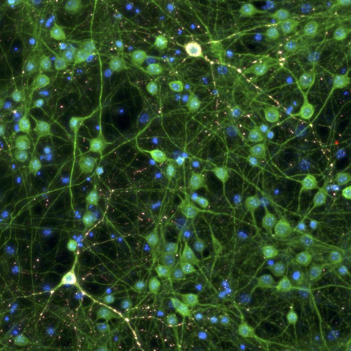 Neurons with red tau aggregates