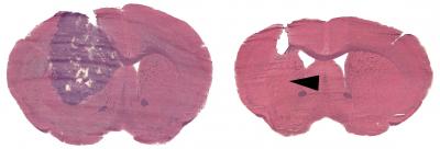 Eradicating Brain Cancer