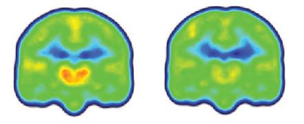 Images Reveal Neuroinflammation in Chronic Pain Patients