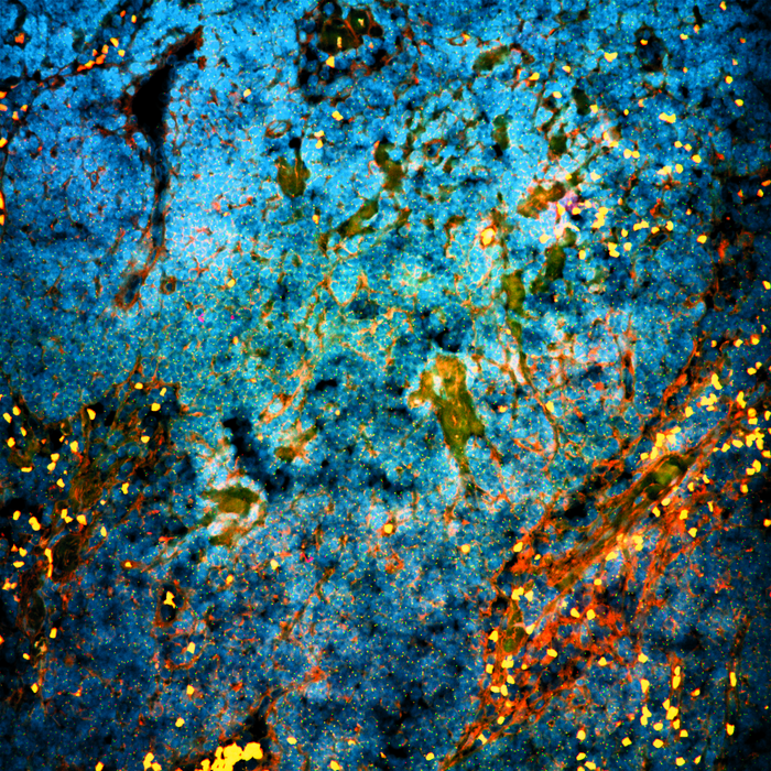 Microscopic image of prostate cancer that has spread to a patient's lymph node copyright NKI