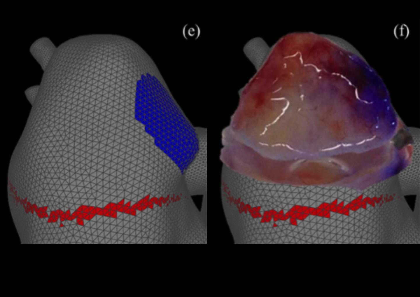 3-D Rendering of Human Aneurysm