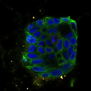 Organoid of a patient with colon cancer