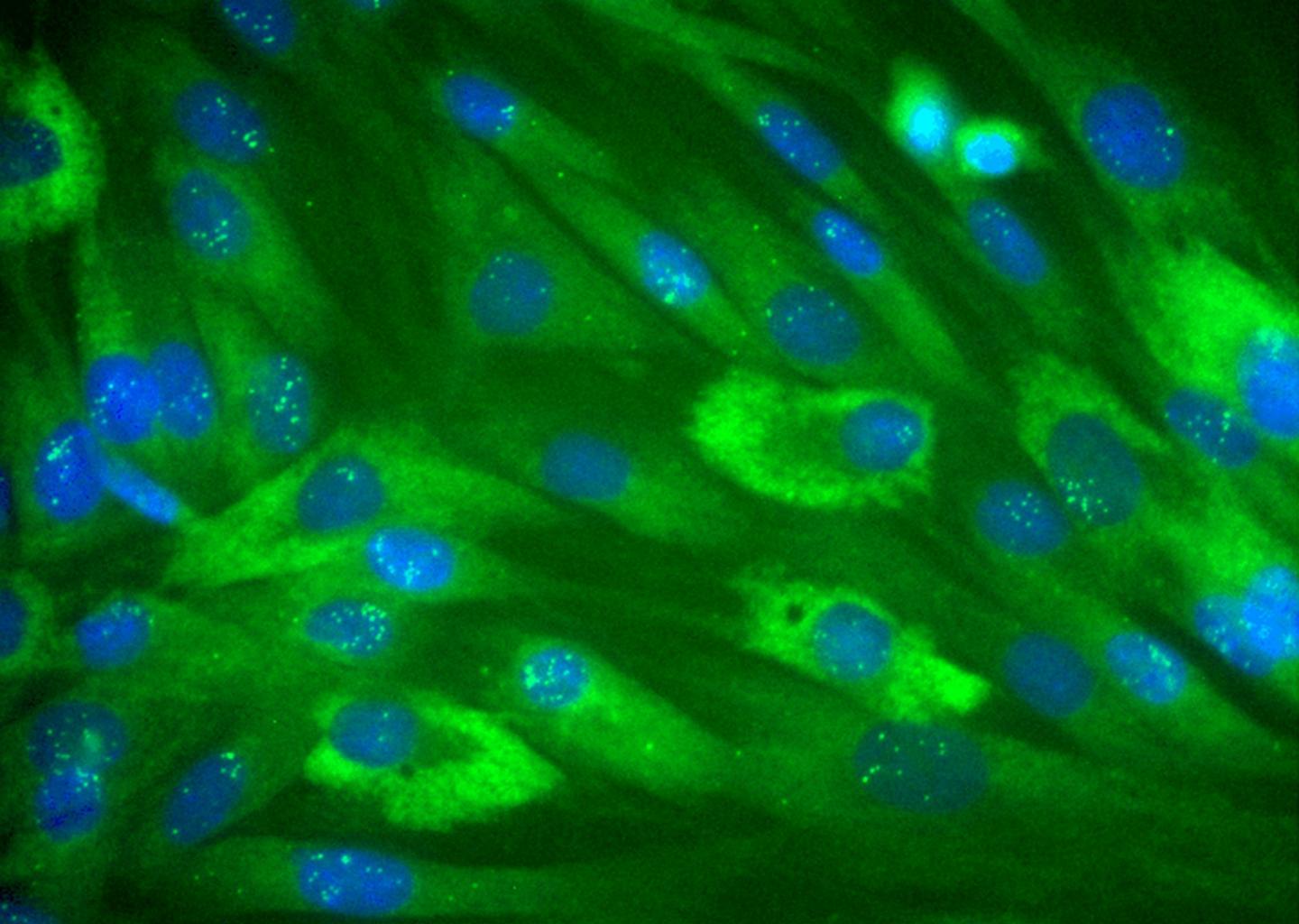 A Promising Target to Treat Myotonic Dystrophy Type 1 (3 of 3)