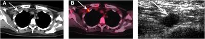 PET/CT Scan Shows Inflammatory Breast Cancer