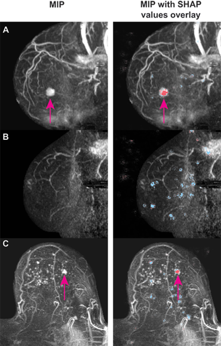 AI Helps Rule Out Cancer in Dense Breasts