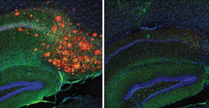 Cholesterol regulates Alzheimer's plaques
