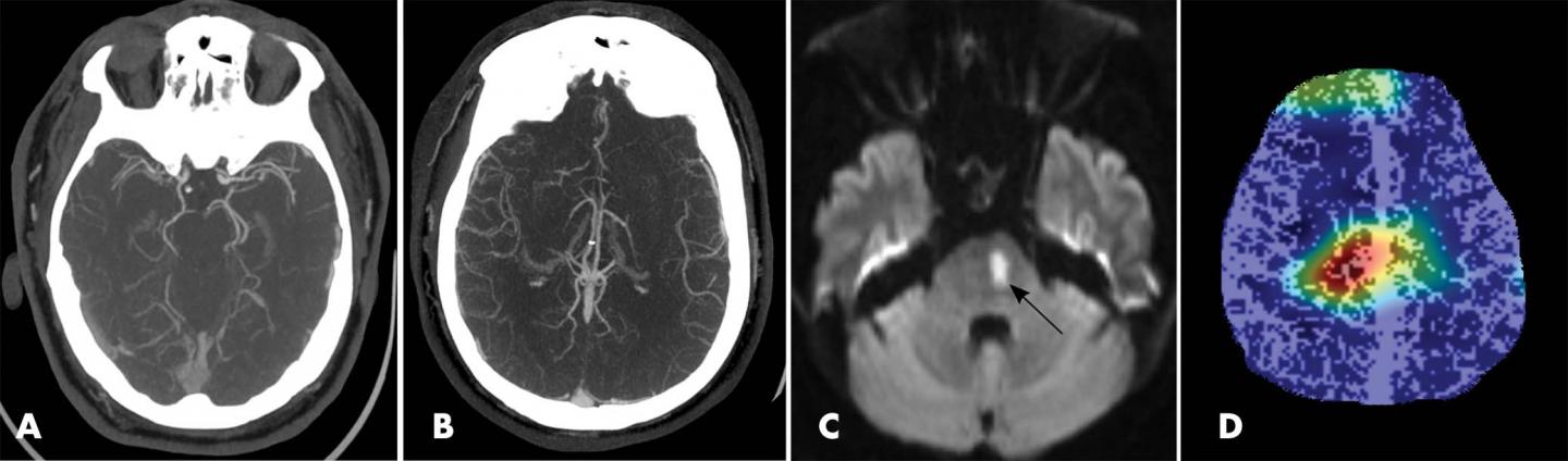 Deep Learning Model Provides Rapid Detection of Stroke-causing Blockages