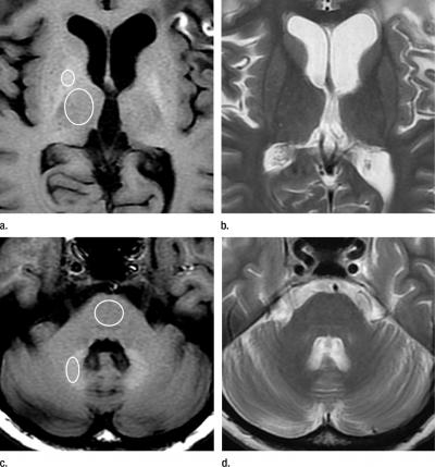 MR Images of Glioblastoma Treatment