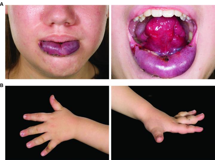 Cancer Gene Drives Vascular Disorder (1 of 2)