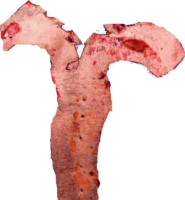 Picture of an Aorta after Dixation
