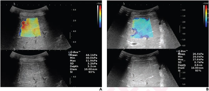 12-Year-Old Boy With Chronic Budd-Chiari Syndrome, Presenting With Recurrent Abdominal Pain and Distention, After Undergoing Left Hepatic Vein Angioplasty