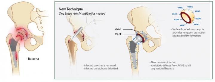 Prosthetic Hip with Vancomycin-Releasing Polymer