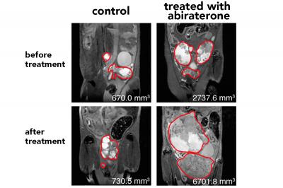 Before and After Treatment with Abiraterone