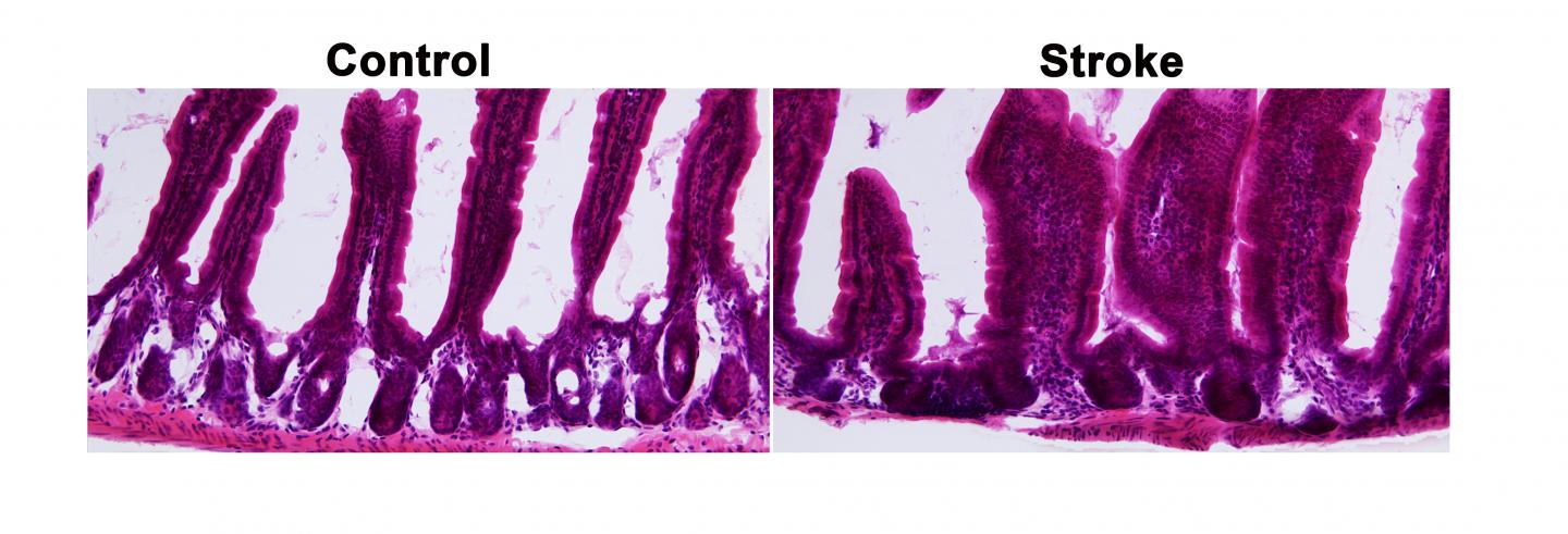 Stroke and Control Intestine
