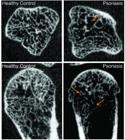 Skin Inflammation Goes Deeper than the Skin, Damaging Bones