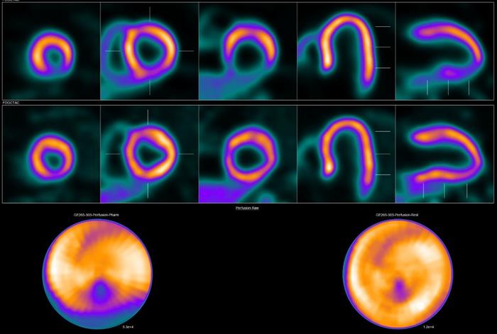 Image showing abnormal 18F-flurpiridaz PET for a 60-year-old female