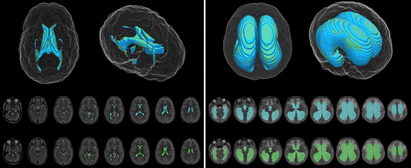 Deep-learning artificial intelligence tool measures volume of cerebral ventricles on MRIs
